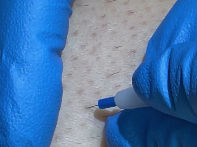 Electrolysis Insertion